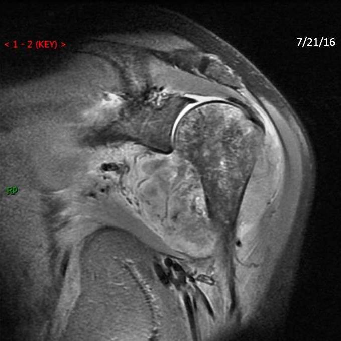 Figure 2 for case Osteosarcoma ( RID4010 ) with a pathologic fracture